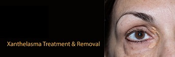 Xanthelasma Removal